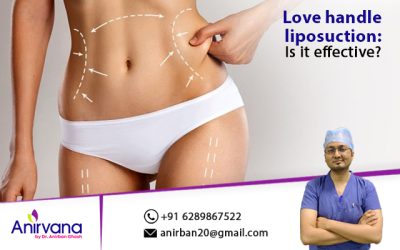  Love handle liposuction: Is it effective?