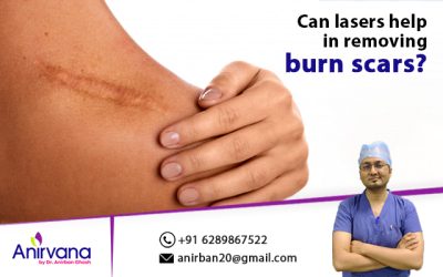 Can lasers help in removing burn scars?