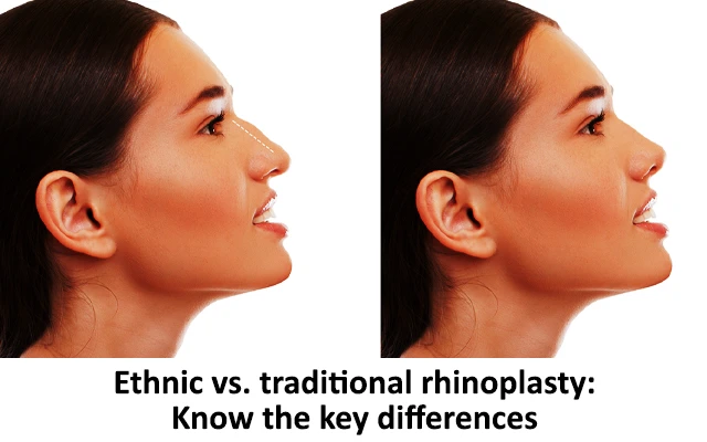 Ethnic vs. traditional rhinoplasty: Know the key differences