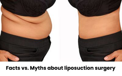 Facts vs. Myths about liposuction surgery