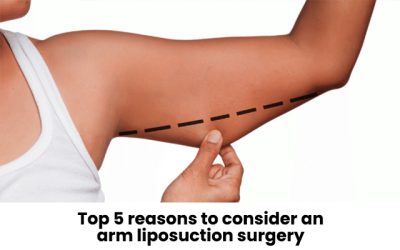 Top 5 reasons to consider an arm liposuction surgery