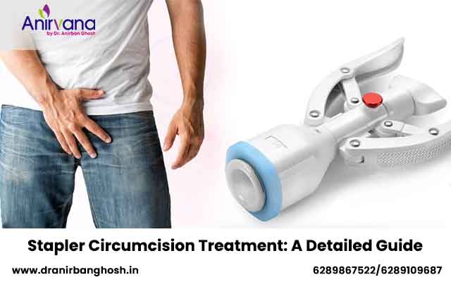 Stapler Circumcision Treatment: A Detailed Guide