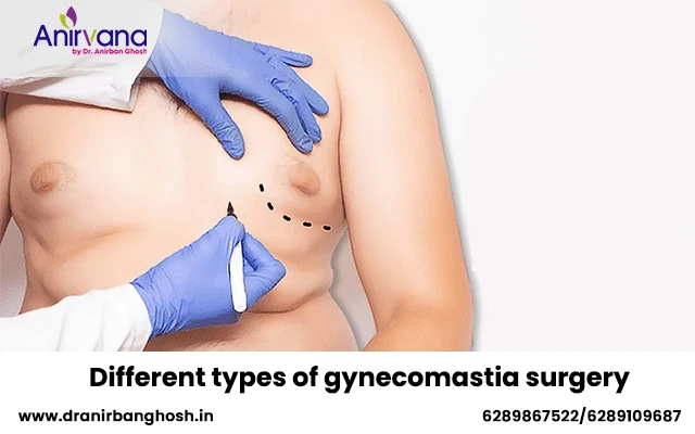 Different types of gynecomastia surgery
