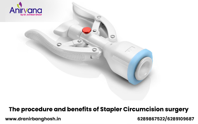 Stapler Circumcision Surgery