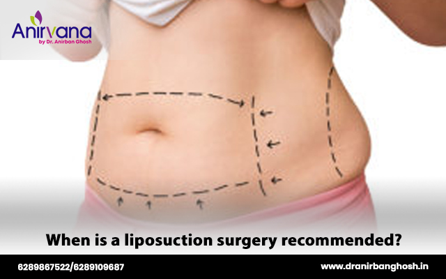 When is liposuction recommended?