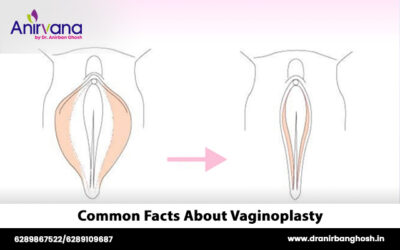 Common Facts About Vaginoplasty