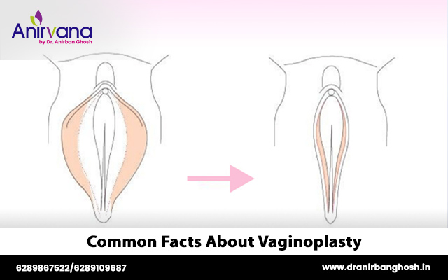 Common Facts About Vaginoplasty