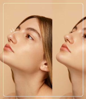 Non-Surgical Rhinoplasty