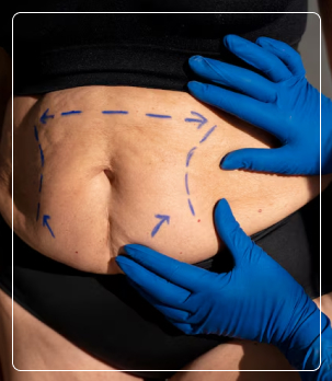 Tummy Tuck