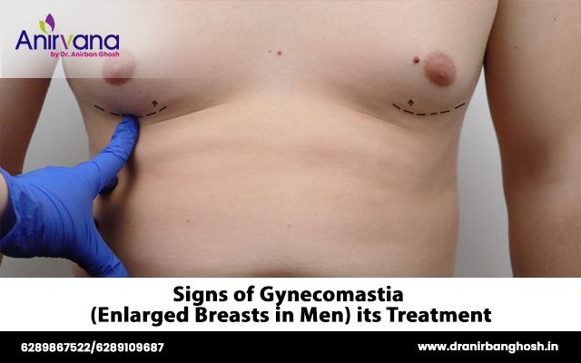 Signs of Gynecomastia (Enlarged Breasts in Men) its Treatment