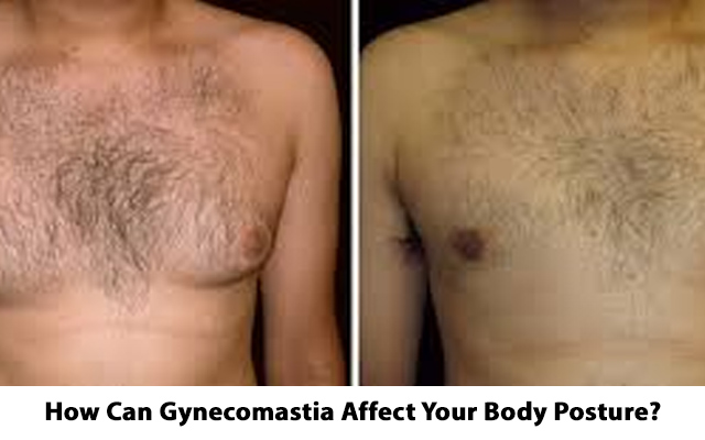 gynecomastia in males