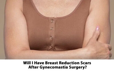  Will I Have Breast Reduction Scars After Gynecomastia Surgery?