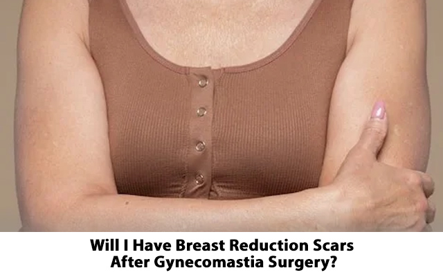  Will I Have Breast Reduction Scars After Gynecomastia Surgery?