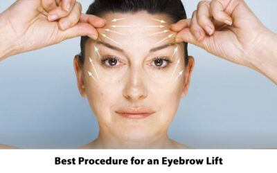 Best Procedure for an Eyebrow Lift