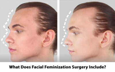 What Does Facial Feminization Surgery Include?