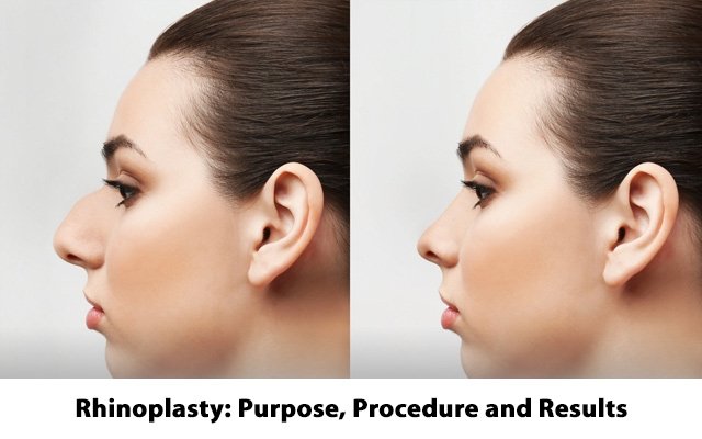 Rhinoplasty surgery in kolkata