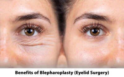 Benefits of Blepharoplasty (Eyelid Surgery)