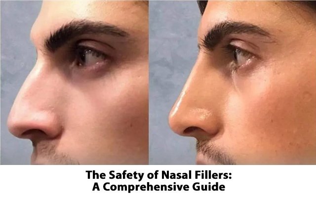 The Safety of Nasal Fillers: A Comprehensive Guide