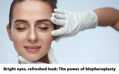 Bright eyes, refreshed look: The power of blepharoplasty