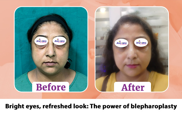 Bright Eyes, Refreshed Look: The Power of Blepharoplasty