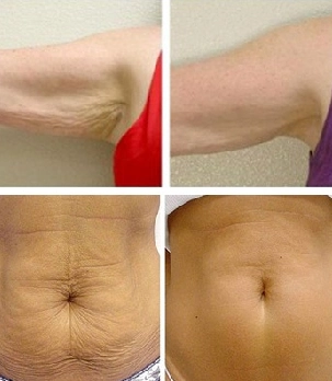 Tummy Tuck, Dr. Anirban Ghosh