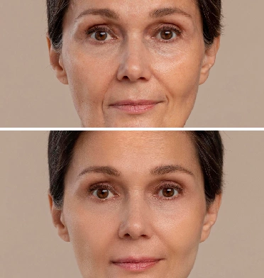 Face Rejuvenation