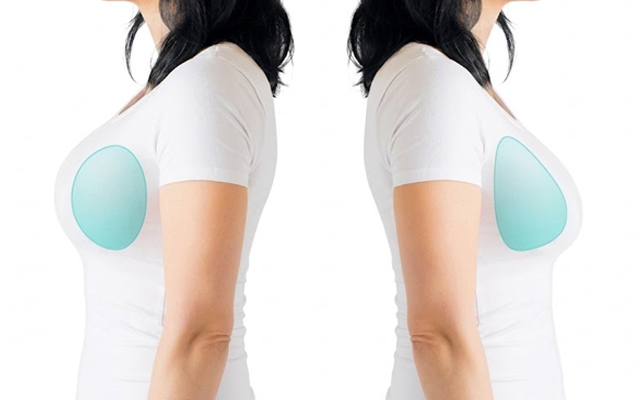 Choose for suitable breast enlargement shape