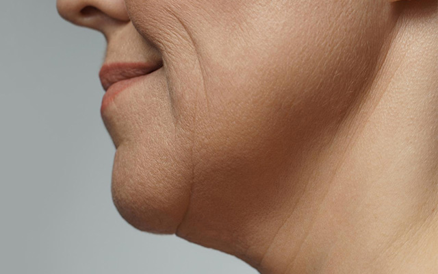 Fuller Face, Weaker Jawline? The Fat Grafting Answer