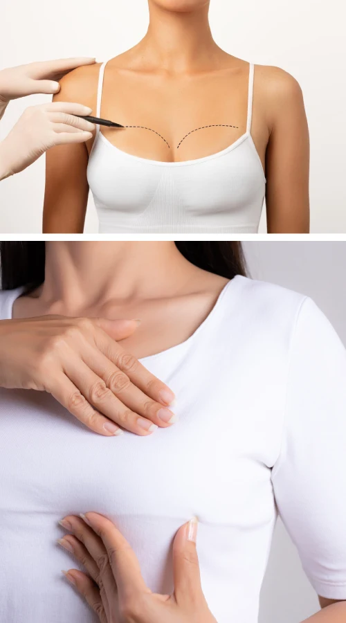 What Happens During Surgery for Breast Reconstruction What Happens During Surgery for Breast Reconstruction