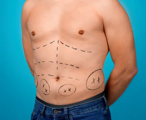 Your Consultation: What to Expect for Gynaecomastia Your Consultation: What to Expect for Gynaecomastia