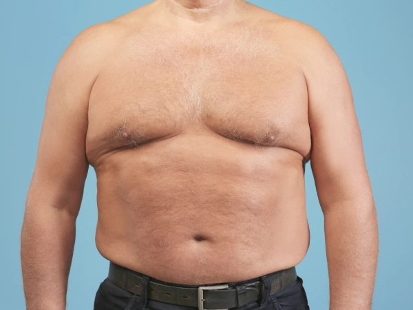 Gynecomastia surgery (male breast reduction) in Kolkata