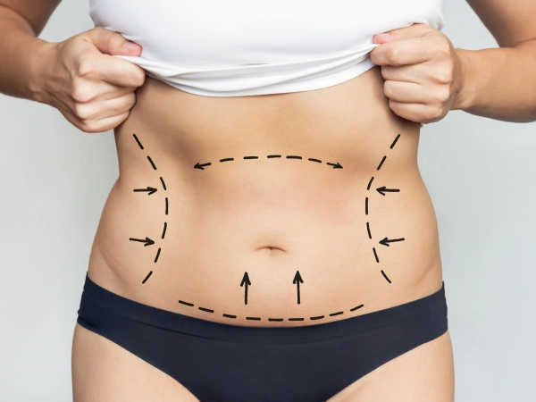 Tummy tuck surgery in Kolkata
